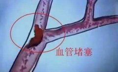 超聲經(jīng)顱多普勒幫您檢查腦血管“堵塞”