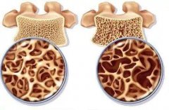超聲骨密度儀品牌：骨質(zhì)變疏松的過程