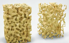 骨量減少跟骨密度是不是一回事 骨密度儀廠家?guī)湍獯? /></a></div>
                        </div>
                        <!-- end of typo-img -->
                        <div   id=