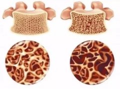 怎樣才能避免過(guò)早發(fā)生骨骼問(wèn)題